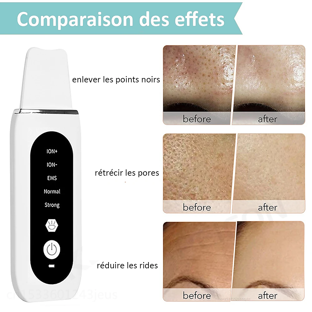 Image of STELLAR - 5-Function EMS Lifting Exfoliator - Ultrasound & Photon Treatment-10